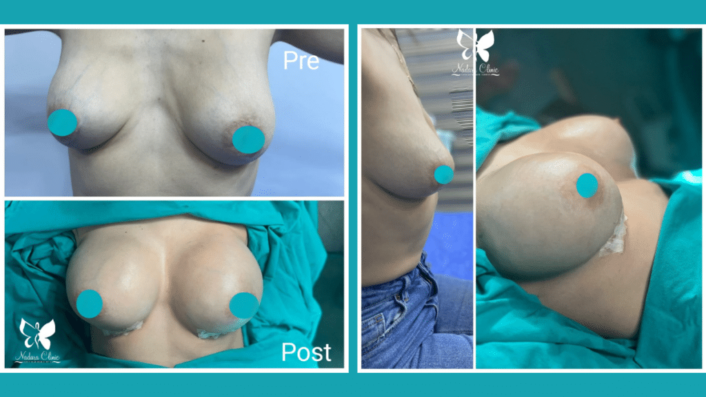 نتائج تكبير الصدر